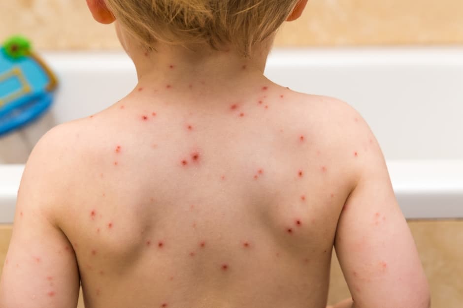 HITNA VAKCINACIJA: Proglašena epidemija malih boginja u Bujanovcu! U Čačku bez evidentiranih slučajeva!