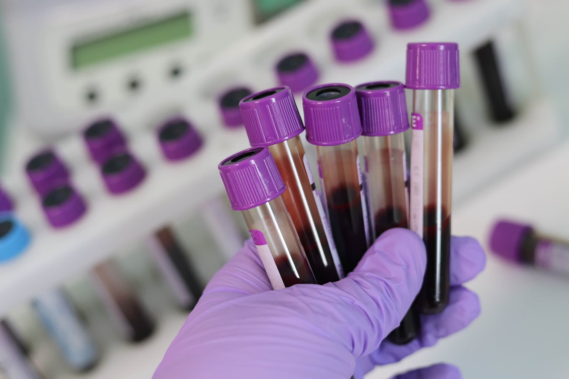 U Srbiji živi 2.756 osoba kojima je dijagnostikovan HIV
