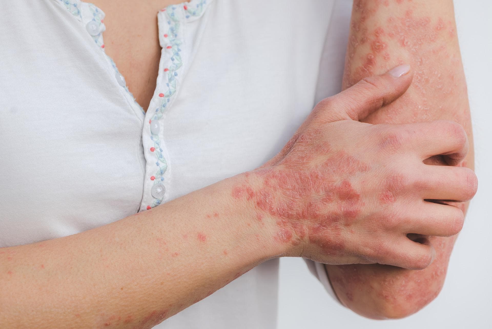 ZA ŽIVOT BEZ PSORIJAZE: Besplatni pregledi za pacijente sa psorijazom u Opštoj bolnici Čačak